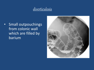 diverticulosis 
• Small outpouchings 
from colonic wall 
which are filled by 
barium 
 