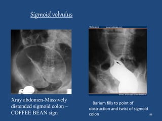 86 
Sigmoid volvulus 
Barium fills to point of 
obstruction and twist of sigmoid 
colon 
Xray abdomen-Massively 
distended sigmoid colon – 
COFFEE BEAN sign 
 
