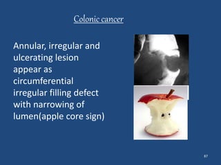 87 
Colonic cancer 
Annular, irregular and 
ulcerating lesion 
appear as 
circumferential 
irregular filling defect 
with narrowing of 
lumen(apple core sign) 
 