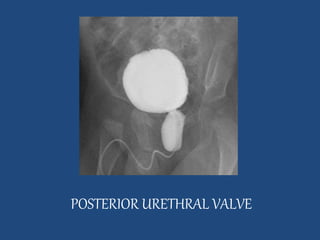 POSTERIOR URETHRAL VALVE 
 