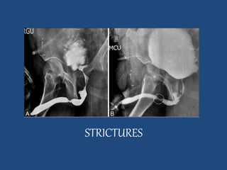 STRICTURES 
 