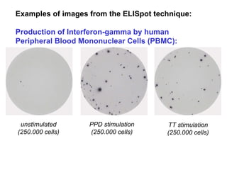 Examples of images from the ELISpot technique: Production of Interferon-gamma by human Peripheral Blood Mononuclear Cells (PBMC):   Interferon-gamma (IFN-  ) Human unstimulated (250.000 cells) PPD stimulation (250.000 cells) TT stimulation (250.000 cells)                                                                                                    