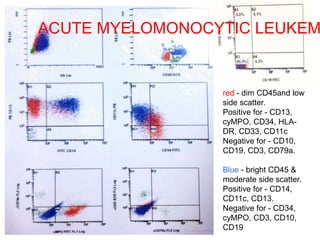 red - dim CD45and low
side scatter.
Positive for - CD13,
cyMPO, CD34, HLA-
DR, CD33, CD11c
Negative for - CD10,
CD19, CD3, CD79a.
Blue - bright CD45 &
moderate side scatter.
Positive for - CD14,
CD11c, CD13.
Negative for - CD34,
cyMPO, CD3, CD10,
CD19
ACUTE MYELOMONOCYTIC LEUKEM
 