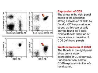 Expression of CD5
The arrow in the right panel
points to the abnormal,
strong expression of CD5 by
B-cells. CD5 expression as
strong as this can usually
only be found on T-cells.
Normal B-cells show no or
only a weak expression of
CD5 (left-hand panel)
Weak expression of CD20
The B-cells in the right panel
show only a weak
expression of CD20 (arrow).
For comparison: normal
CD20 expression in the left-
hand panel.
 