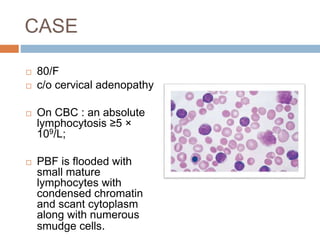  80/F
 c/o cervical adenopathy
 On CBC : an absolute
lymphocytosis ≥5 ×
109/L;
 PBF is flooded with
small mature
lymphocytes with
condensed chromatin
and scant cytoplasm
along with numerous
smudge cells.
CASE
 