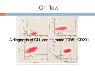 On flow
A diagnosis of CLL can be made. CD5+ CD23+
 