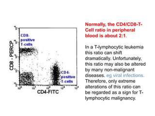 Normally, the CD4/CD8-T-
Cell ratio in peripheral
blood is about 2:1.
In a T-lymphocytic leukemia
this ratio can shift
dramatically. Unfortunately,
this ratio may also be altered
by many non-malignant
diseases. eg viral infections.
Therefore, only extreme
alterations of this ratio can
be regarded as a sign for T-
lymphocytic malignancy.
 
