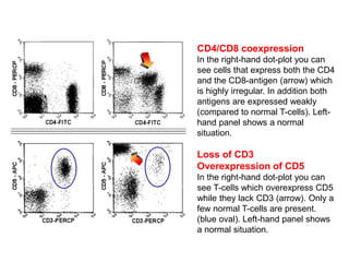 CD4/CD8 coexpression
In the right-hand dot-plot you can
see cells that express both the CD4
and the CD8-antigen (arrow) which
is highly irregular. In addition both
antigens are expressed weakly
(compared to normal T-cells). Left-
hand panel shows a normal
situation.
Loss of CD3
Overexpression of CD5
In the right-hand dot-plot you can
see T-cells which overexpress CD5
while they lack CD3 (arrow). Only a
few normal T-cells are present.
(blue oval). Left-hand panel shows
a normal situation.
 