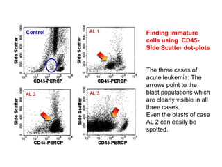 Finding immature
cells using CD45-
Side Scatter dot-plots
The three cases of
acute leukemia: The
arrows point to the
blast populations which
are clearly visible in all
three cases.
Even the blasts of case
AL 2 can easily be
spotted.
 
