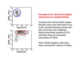 Example of an abnormal antigen
expression on myeloid blasts
Compare the normal blasts (upper
dot-plot, blue oval) with those of an
acute myeloid leukemia (lower dot-
plot, red oval)): the malignant
blasts abnormally express CD15
and they show an increased
expression of CD34.
Note: CD34-negative cells have
been removed for reason of clarity.
 