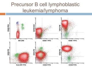 Precursor B cell lymphoblastic
leukemia/lymphoma
 