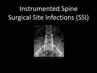 Instrumented Spine
Surgical Site Infections (SSI)




         source: AAOS orthopaedic knowledge online
 