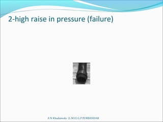 2-high raise in pressure (failure)
A N Khudaiwala (L.M.E) G.P.PORBANDAR
 