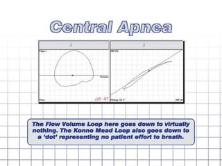 Flow volume loop quick loop guide | PPT