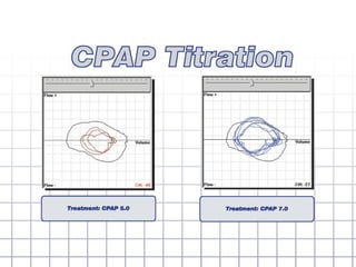 Flow volume loop quick loop guide | PPT