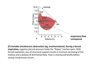 (F) Variable  i ntrathoracic obstruction (eg, tracheomalacia). During a forced inspiration,  negative pleural pressure holds the “floppy” trachea open. With forced expiration, loss of structural support results in tracheal narrowing of the trachea and a plateau of diminished flow. Flow is maintained briefly before airway compression occurs. I nspiratory flow  unimpaired 