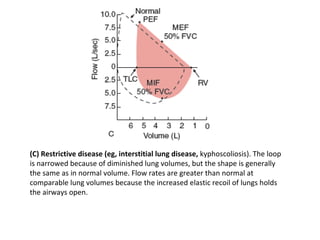 Kyphoscoliosis Flow Volume Loop