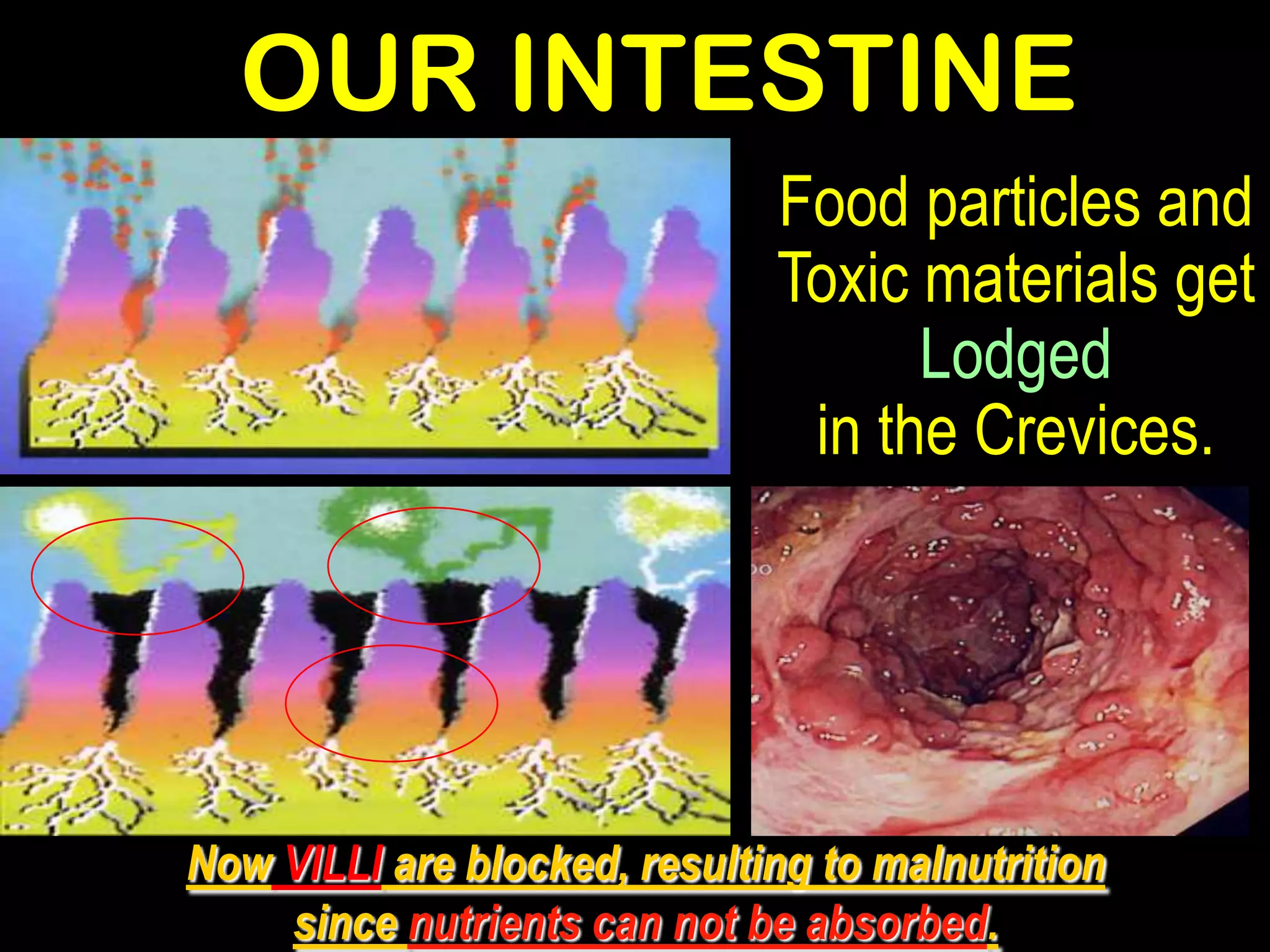 OUR INTESTINE
                              Food particles and
                              Toxic materials get
                                    Lodged
                               in the Crevices.




Now VILLI are blocked, resulting to malnutrition
    since nutrients can not be absorbed.
 