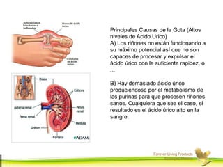 Forever Living Products
Ecatepec,Mexico
Principales Causas de la Gota (Altos
niveles de Acido Urico)
A) Los riñones no están funcionando a
su máximo potencial así que no son
capaces de procesar y expulsar el
ácido úrico con la suficiente rapidez, o
...
B) Hay demasiado ácido úrico
produciéndose por el metabolismo de
las purinas para que procesen riñones
sanos. Cualquiera que sea el caso, el
resultado es el ácido úrico alto en la
sangre.
 
