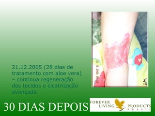 30 DIAS DEPOIS 21.12.2005 (28 dias de tratamento com aloe vera) – contínua regeneração dos tecidos e cicatrização avançada. 