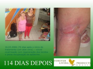 114 DIAS DEPOIS 16.03.2006 (70 dias após o início do tratamento com aloe vera) – visível cicatrização com regeneração dos tecidos e plena recuperação da epiderme. 