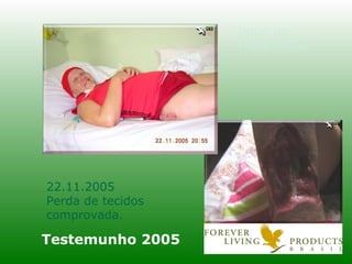 Testemunho 2005 Início do Tratamento 22.11.2005 Perda de tecidos comprovada. 