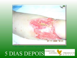 5 DIAS DEPOIS 5 dias depois – contínua regeneração de tecidos e cicatrização. 