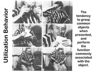 UtilizationBehavior
The
tendency
to grasp
common
objects
when
presented,
and
perform
the
function
commonly
associated
with the
object.
 