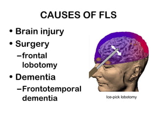 CAUSES OF FLS
• Brain injury
• Surgery
–frontal
lobotomy
• Dementia
–Frontotemporal
dementia Ice-pick lobotomy
 