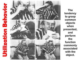 UtilizationBehavior
The
tendency
to grasp
common
objects
when
presented,
and
perform
the
function
commonly
associated
with the
object.
 