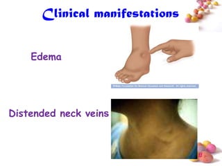 Clinical manifestations


    Edema




Distended neck veins



                                #
 