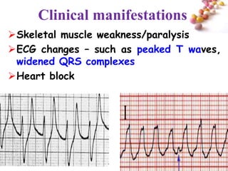 Clinical manifestations
Skeletal muscle weakness/paralysis
ECG changes – such as peaked T waves,
 widened QRS complexes
Heart block




                                  #
 