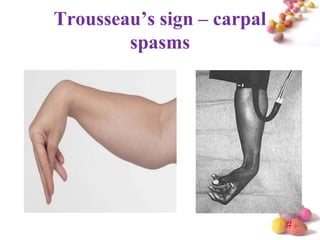 Trousseau’s sign – carpal
        spasms




                            #
 