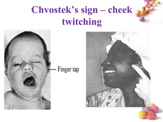 Chvostek’s sign – cheek
      twitching




                          #
 