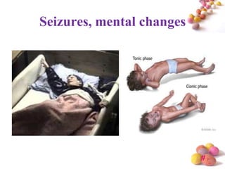 Seizures, mental changes




                           #
 