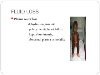 FLUID LOSS
Plasma water loss
           dehydration,anaemia
           polycythemia,heart failure
           hypoalbuminemia,
           abnormal plasma osmolality
 
