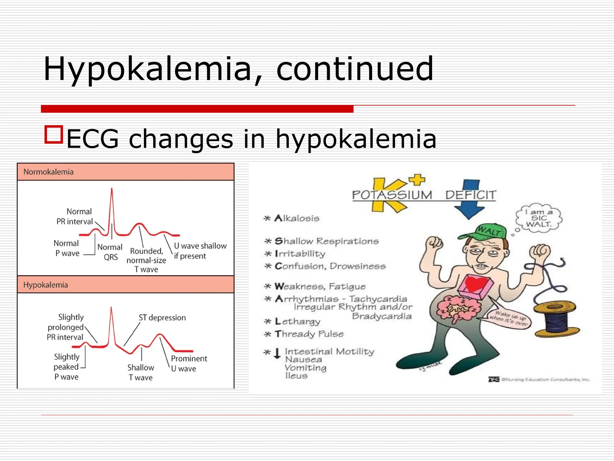 Hypokalemia, continued
ECG changes in hypokalemia
 