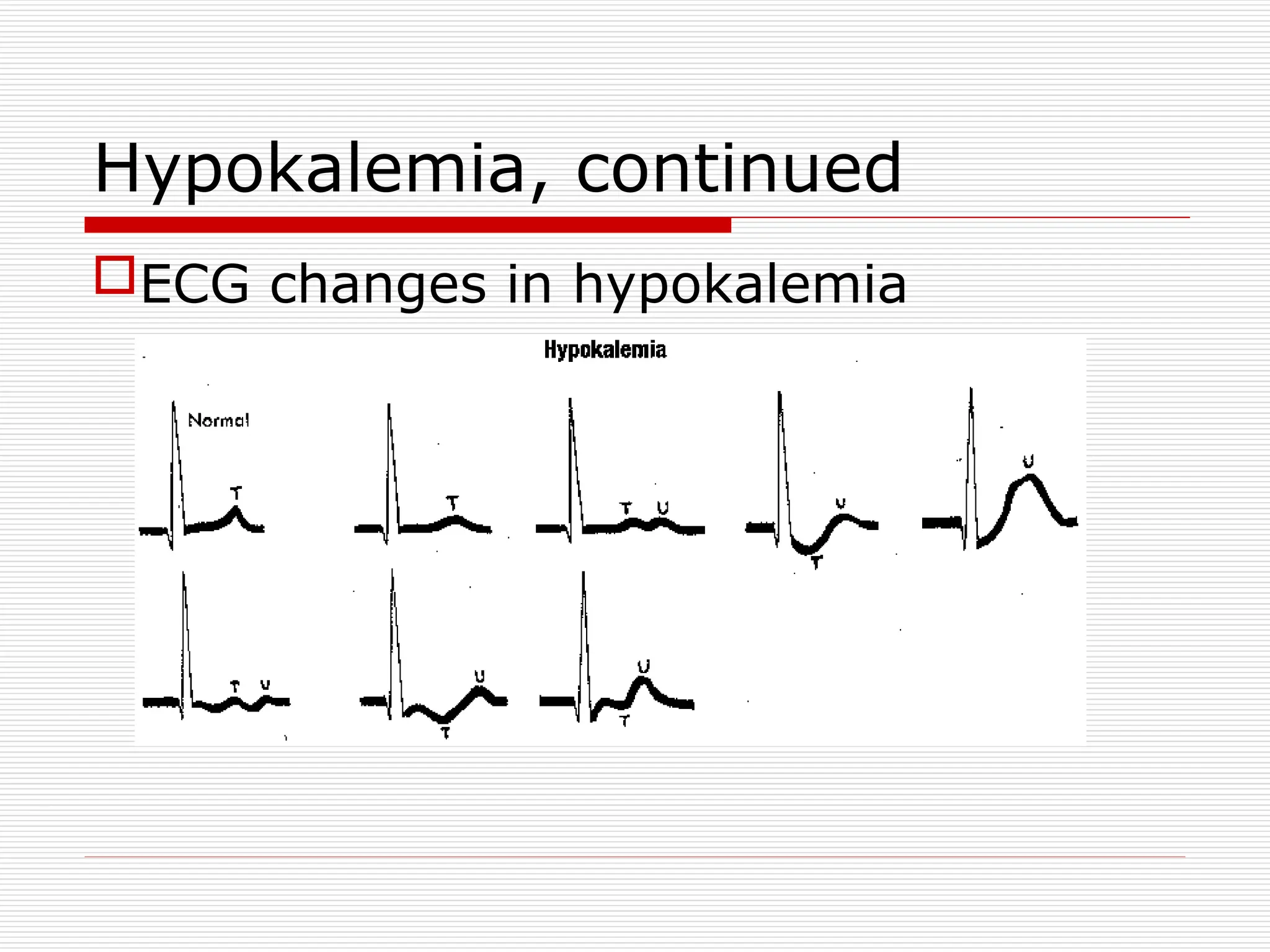 Hypokalemia, continued
ECG changes in hypokalemia
 