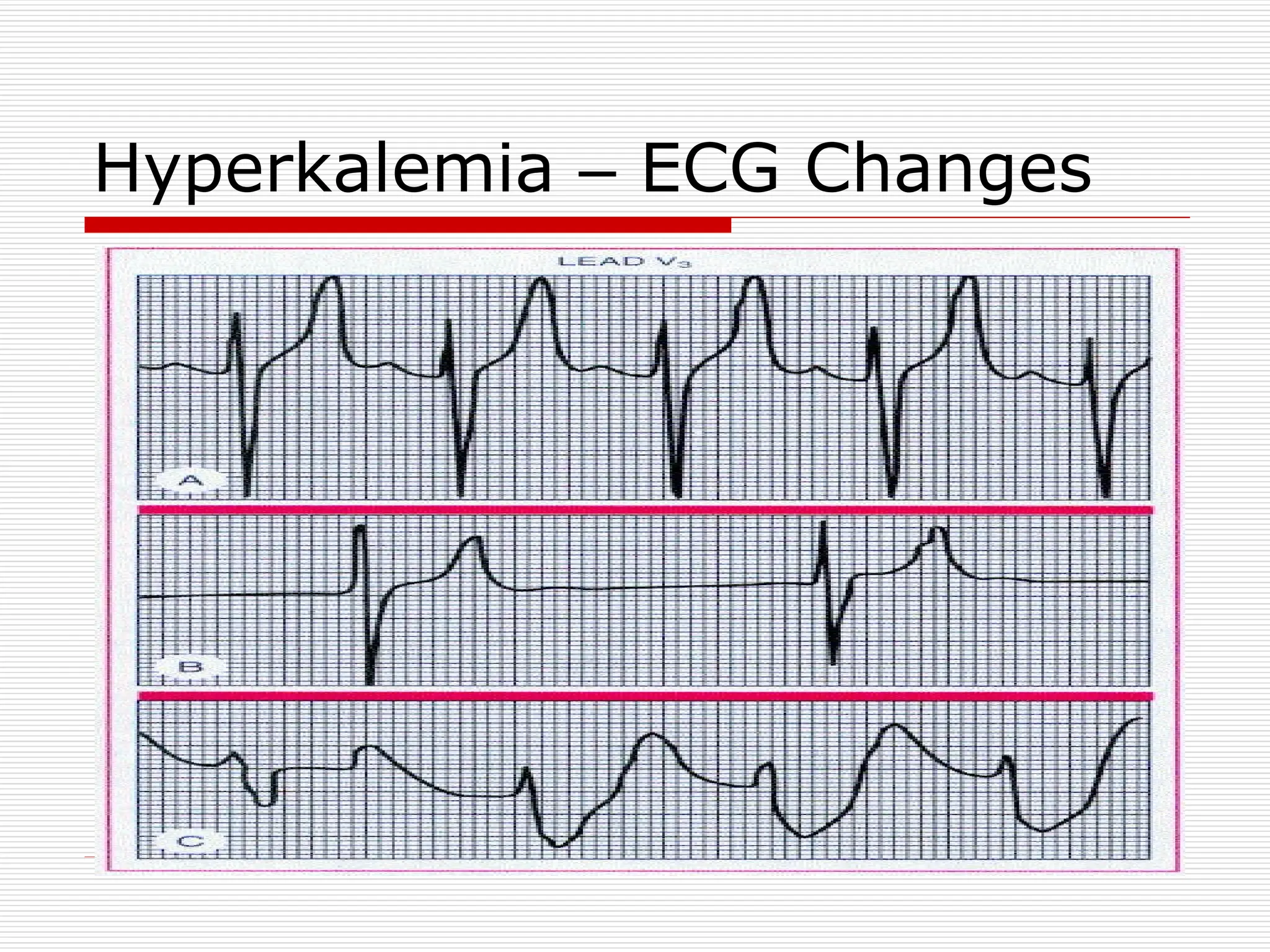 Hyperkalemia – ECG Changes
 