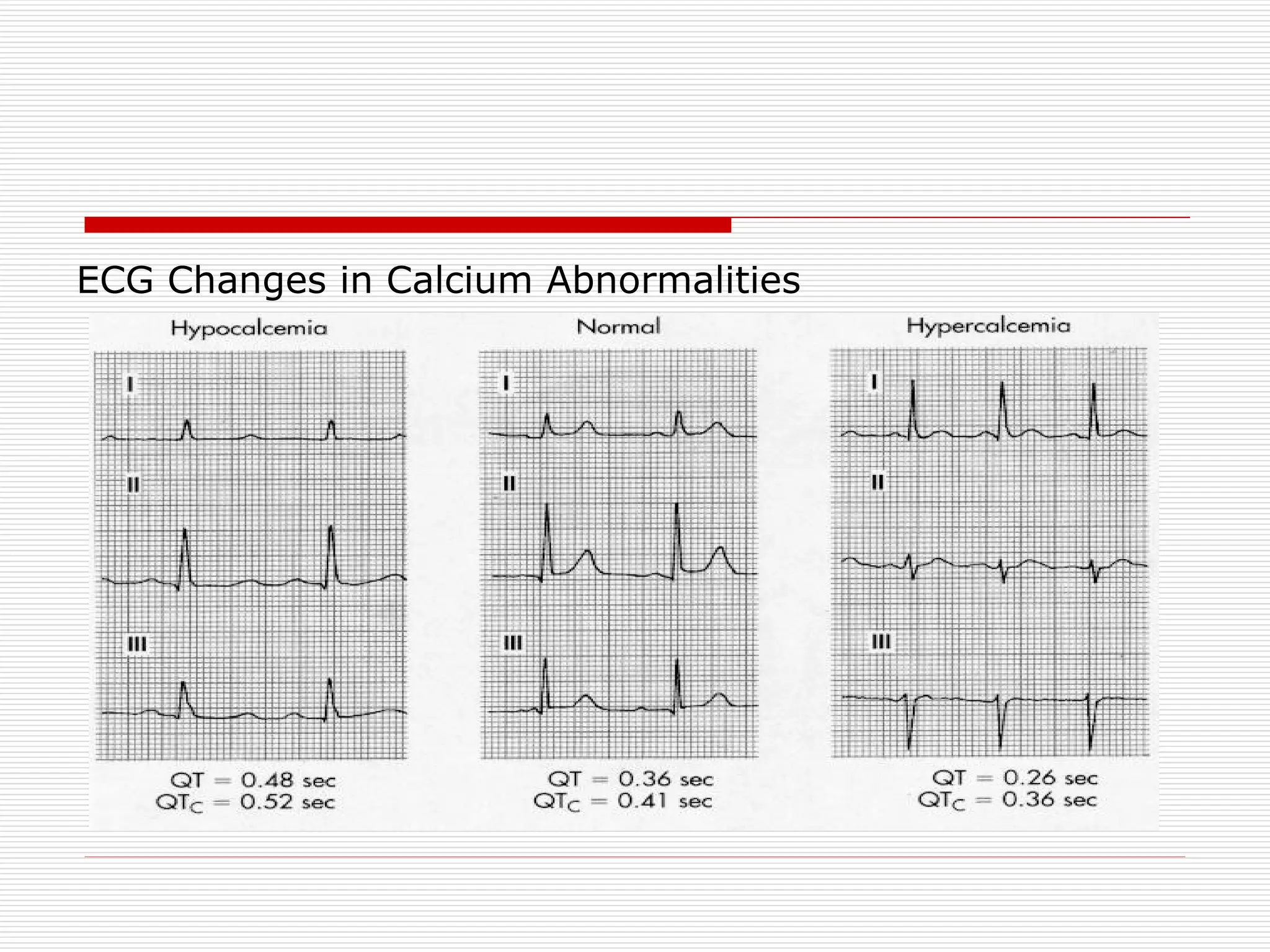 ECG Changes in Calcium Abnormalities
 