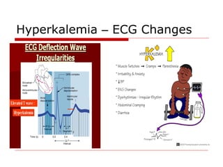 Hyperkalemia – ECG Changes
 