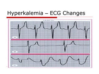 Hyperkalemia – ECG Changes
 