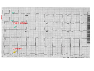 Flat T waves




U waves
 