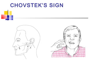 CHOVSTEK’S SIGN
 