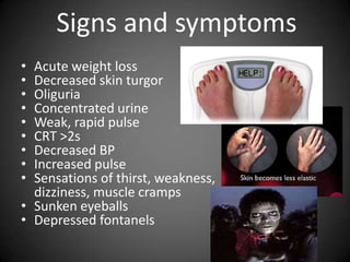 Signs and symptomsAcute weight lossDecreased skin turgorOliguriaConcentrated urineWeak, rapid pulseCRT >2sDecreased BPIncreased pulseSensations of thirst, weakness, 	dizziness, muscle crampsSunken eyeballsDepressed fontanels