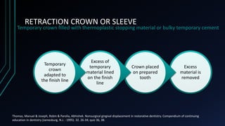 RETRACTION CROWN OR SLEEVE
Temporary crown ﬁlled with thermoplastic stopping material or bulky temporary cement
Excess
mat...