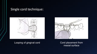 Single cord technique:
Looping of gingival cord Cord placement from
mesial surface
 
