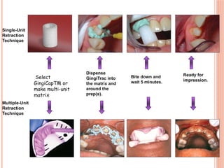 Retraction Unit Model Fluid control and Soft tissue management in Fixed.pptx