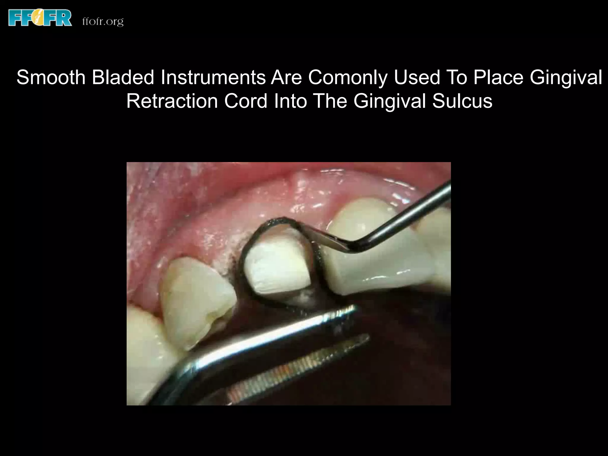 Serrated Instruments Can Lift Cords Out Of The SulcusSmooth Bladed Instruments Are Comonly Used To Place Gingival
Retraction Cord Into The Gingival Sulcus
 