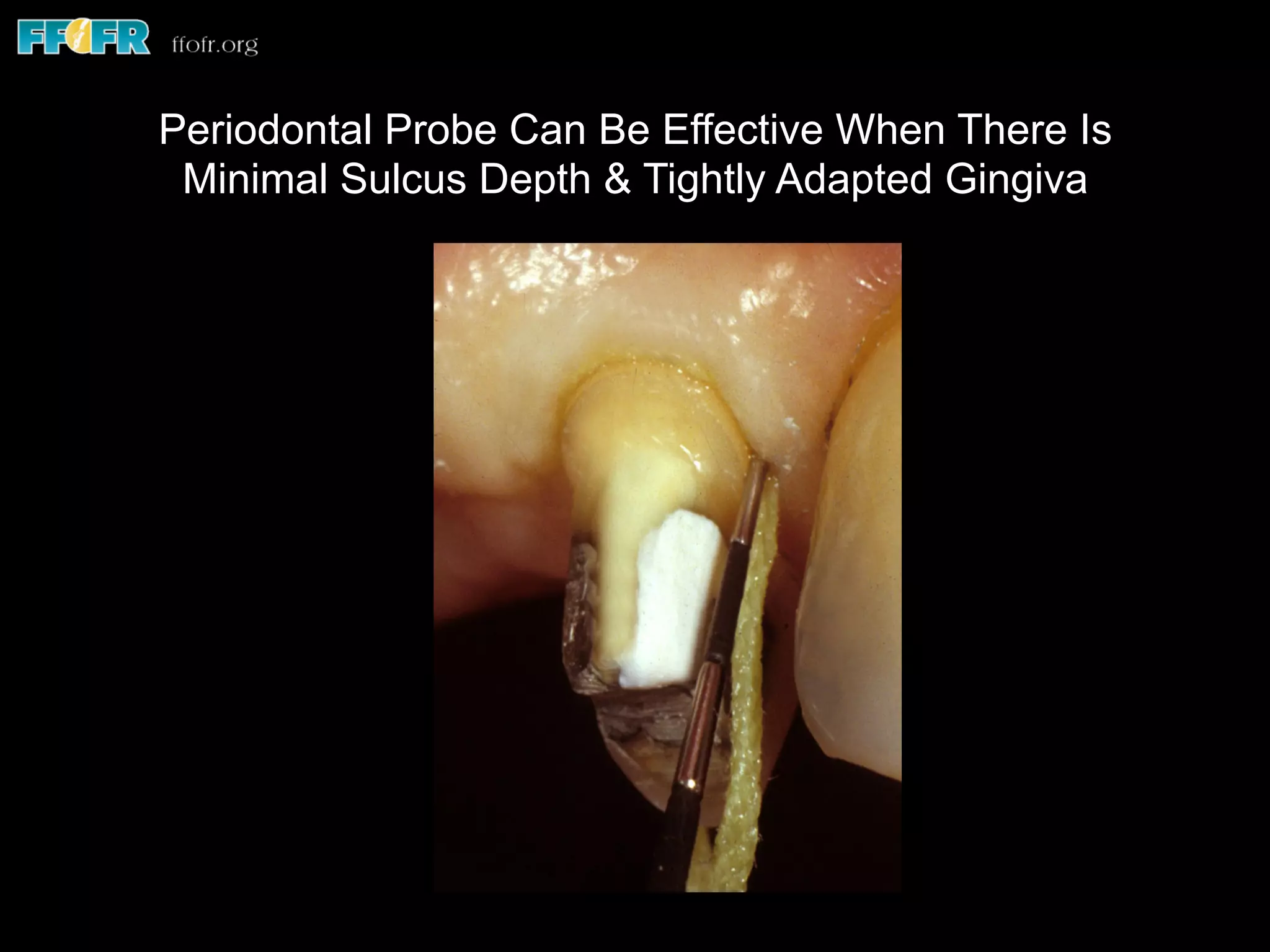 Periodontal Probe Can Be Effective When There Is
Minimal Sulcus Depth & Tightly Adapted Gingiva
 